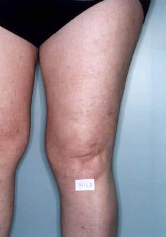 Legs after Spider Vein Treatment