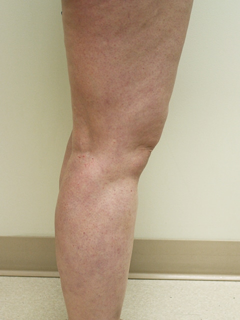 Legs After Spider vein treatment